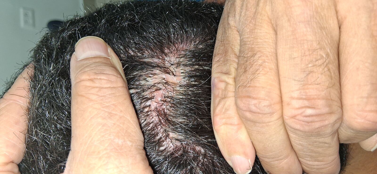 Clinical case: Folliculitis decalvans