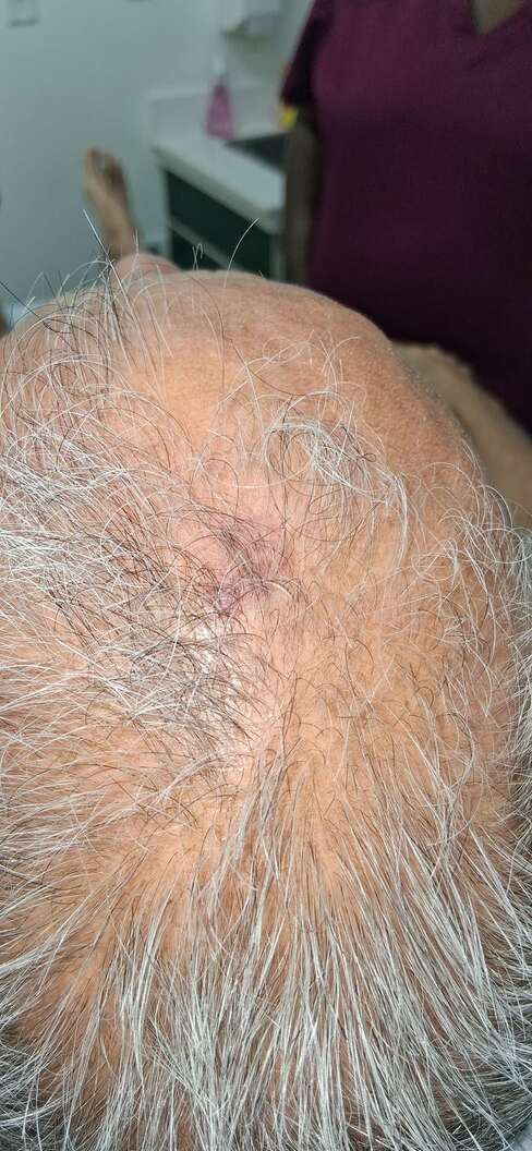 Clinical case: Capillary hemangioma and frontal nevus flammeus