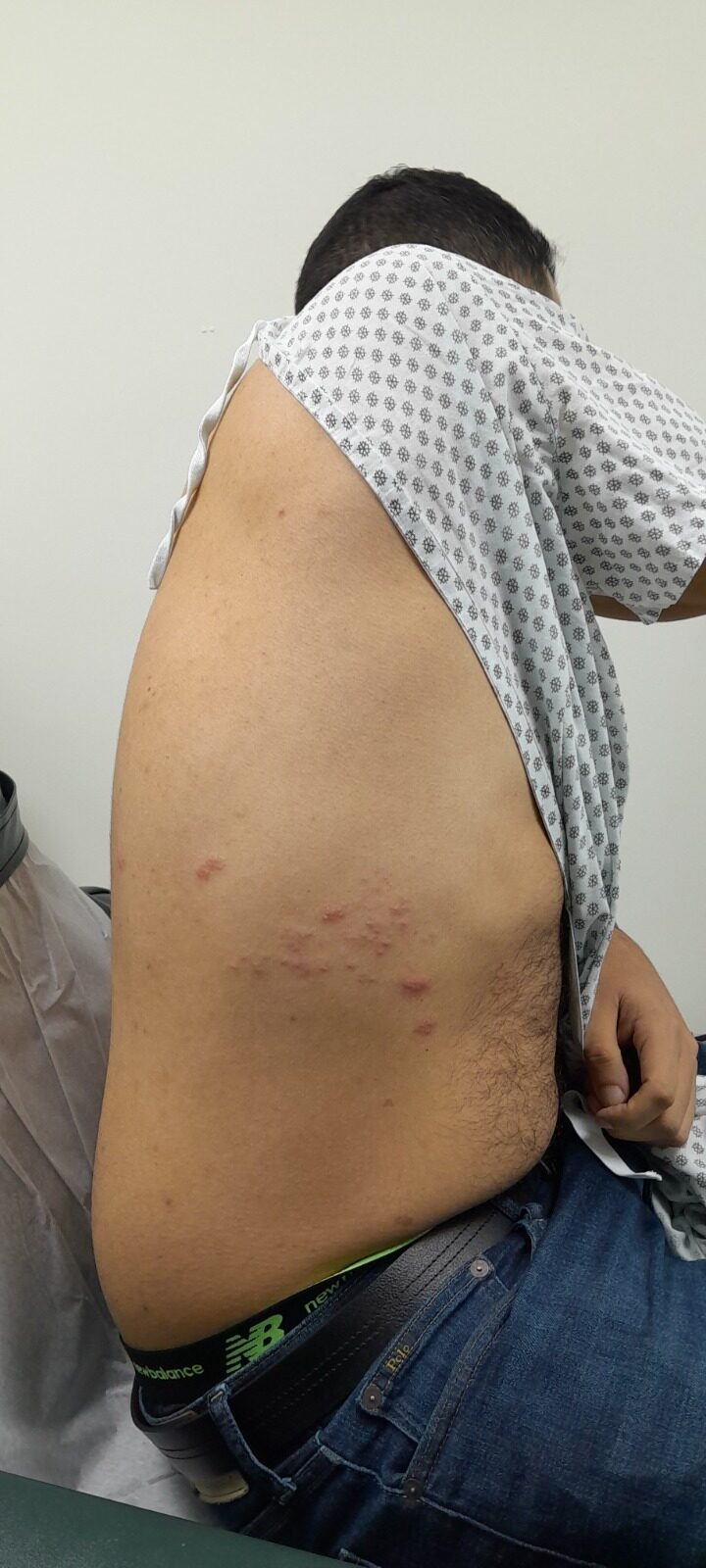 Herpes zoster: before image