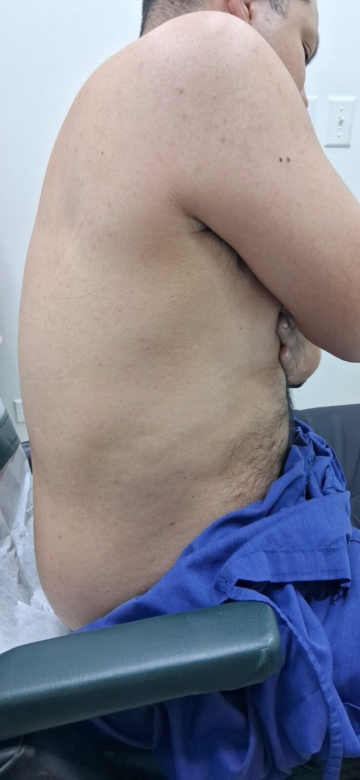 Herpes zoster: after image