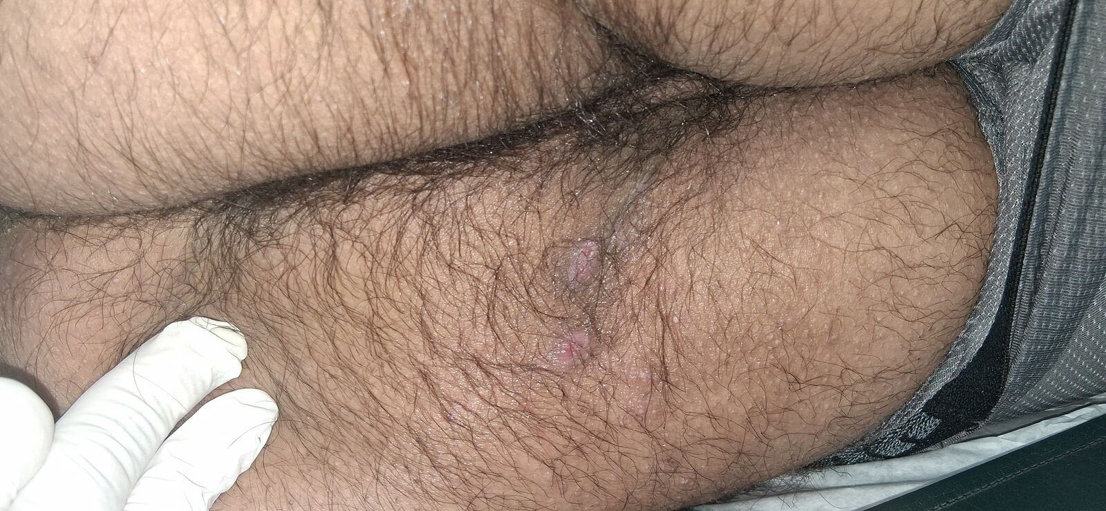 Hidradenitis suppurativa: before image