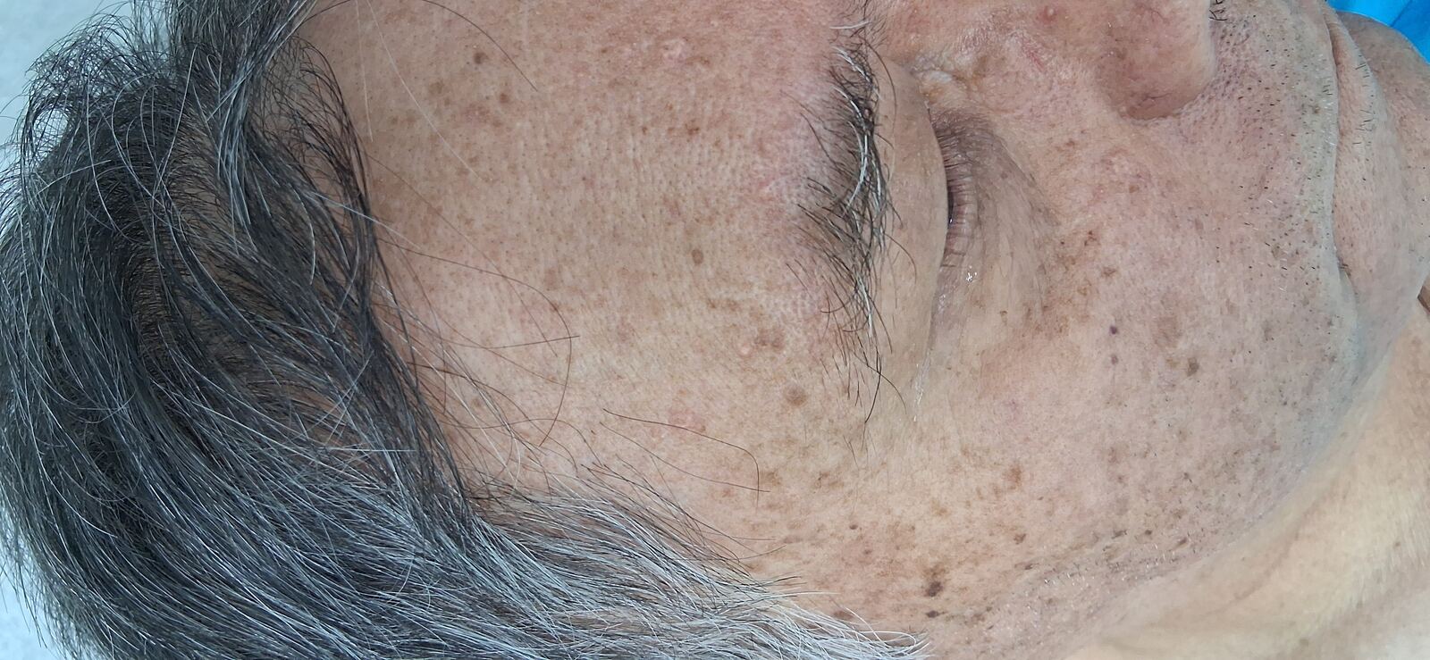 Clinical case: Sebaceous hyperplasia