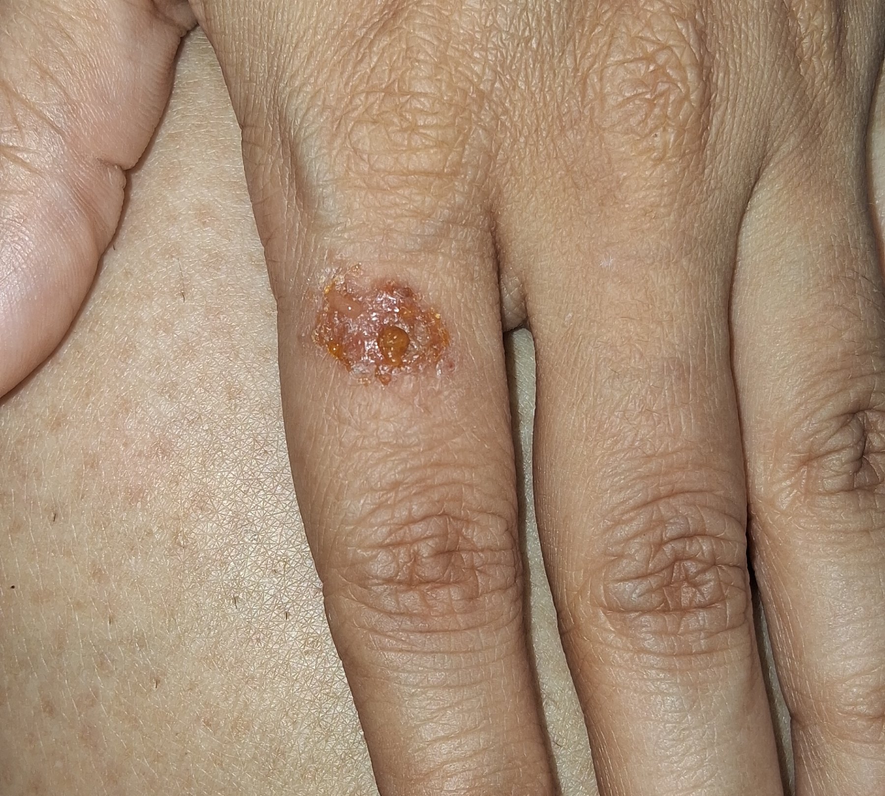 Impetigo contagiosa: before image