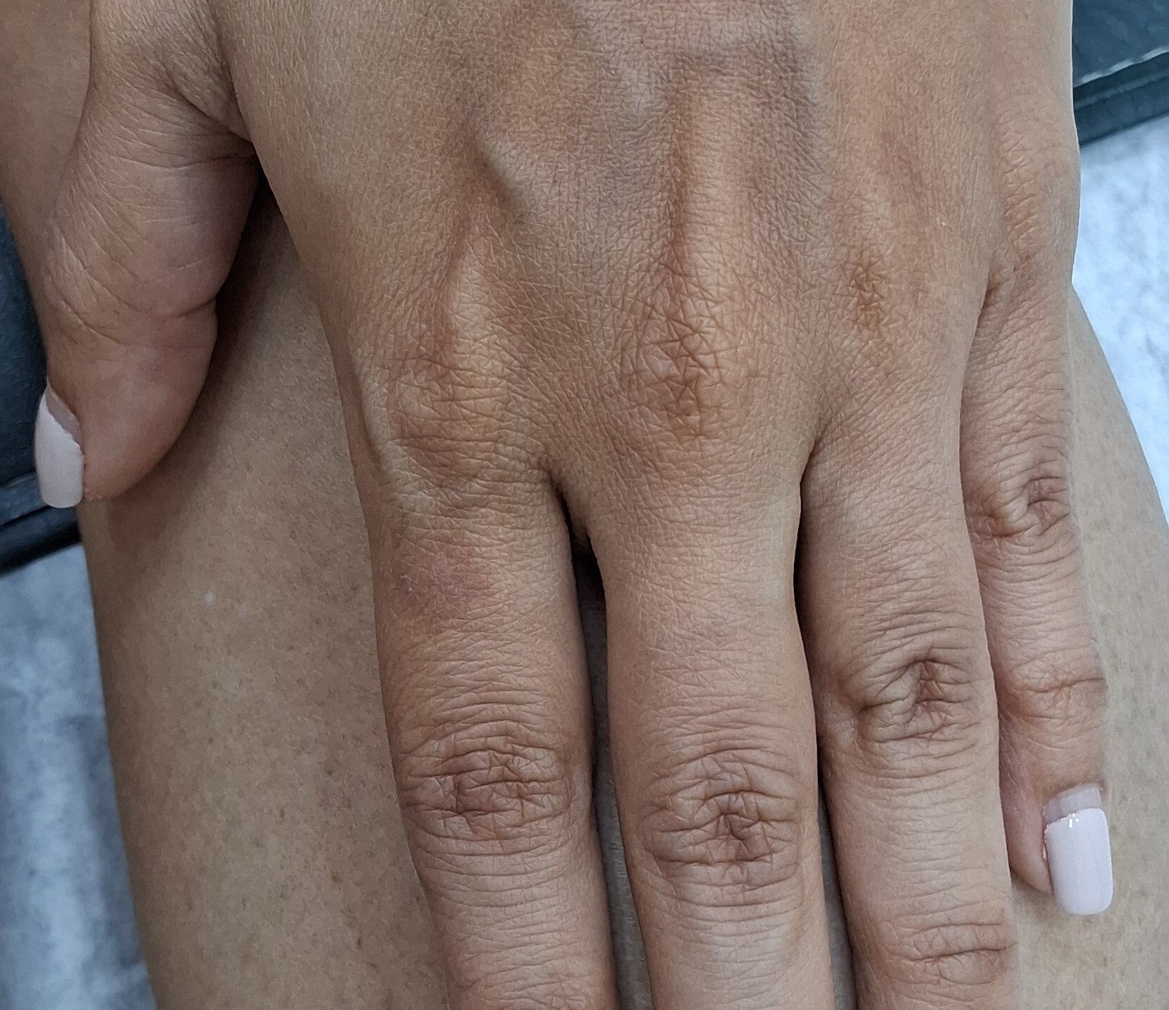Impetigo contagiosa: after image