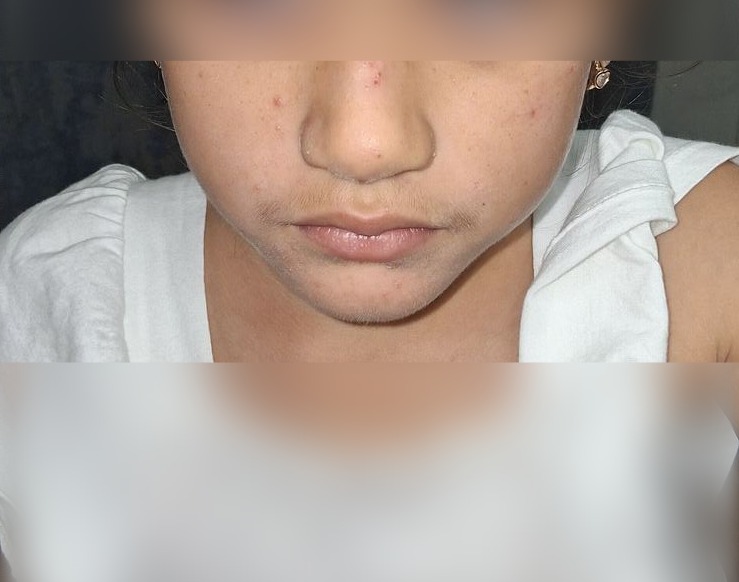 Clinical case: Impetigo contagiosa