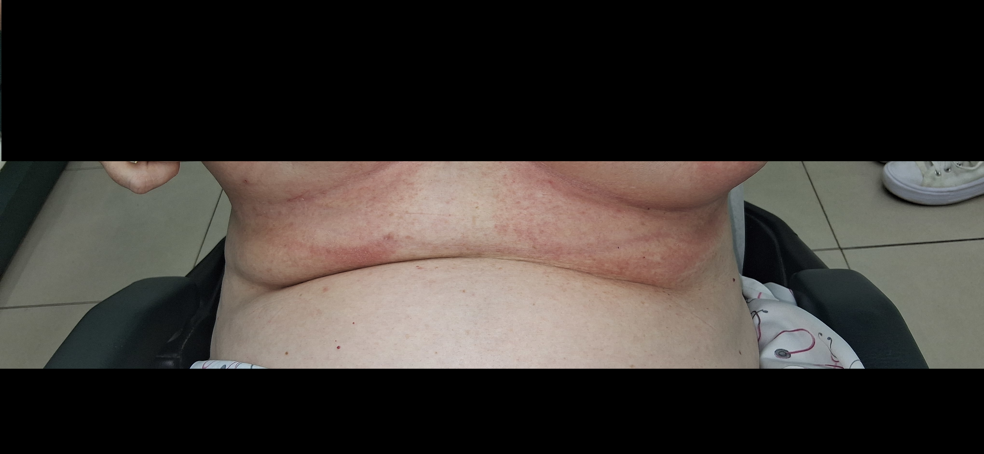 Intertrigo: before image