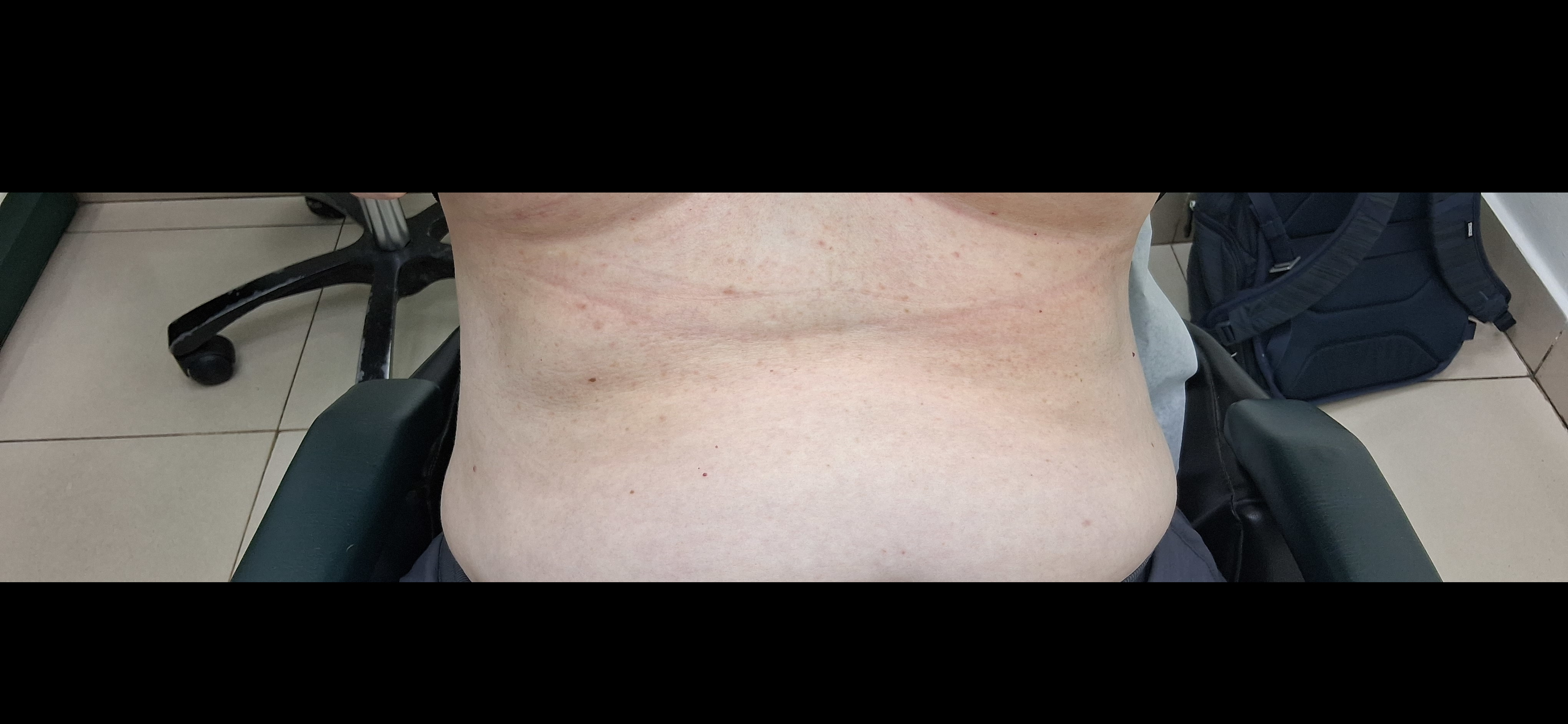 Intertrigo: after image