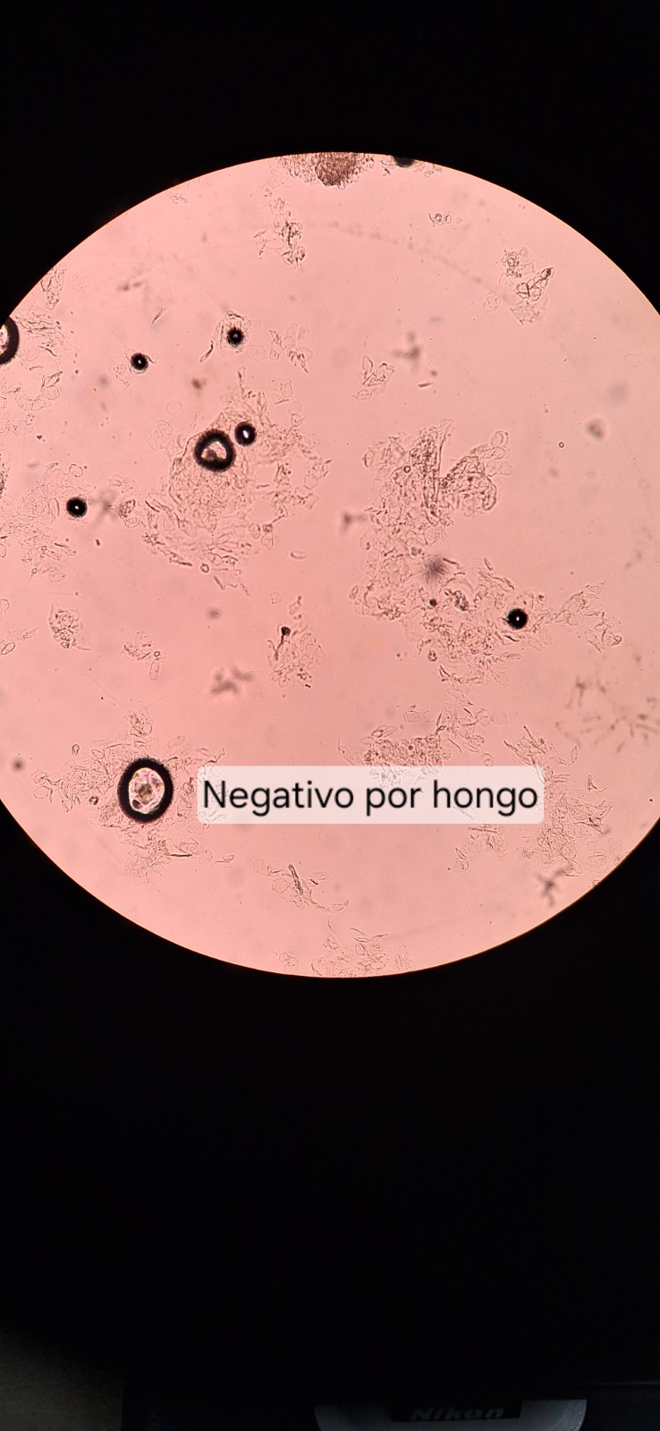 Clinical case of Intertrigo