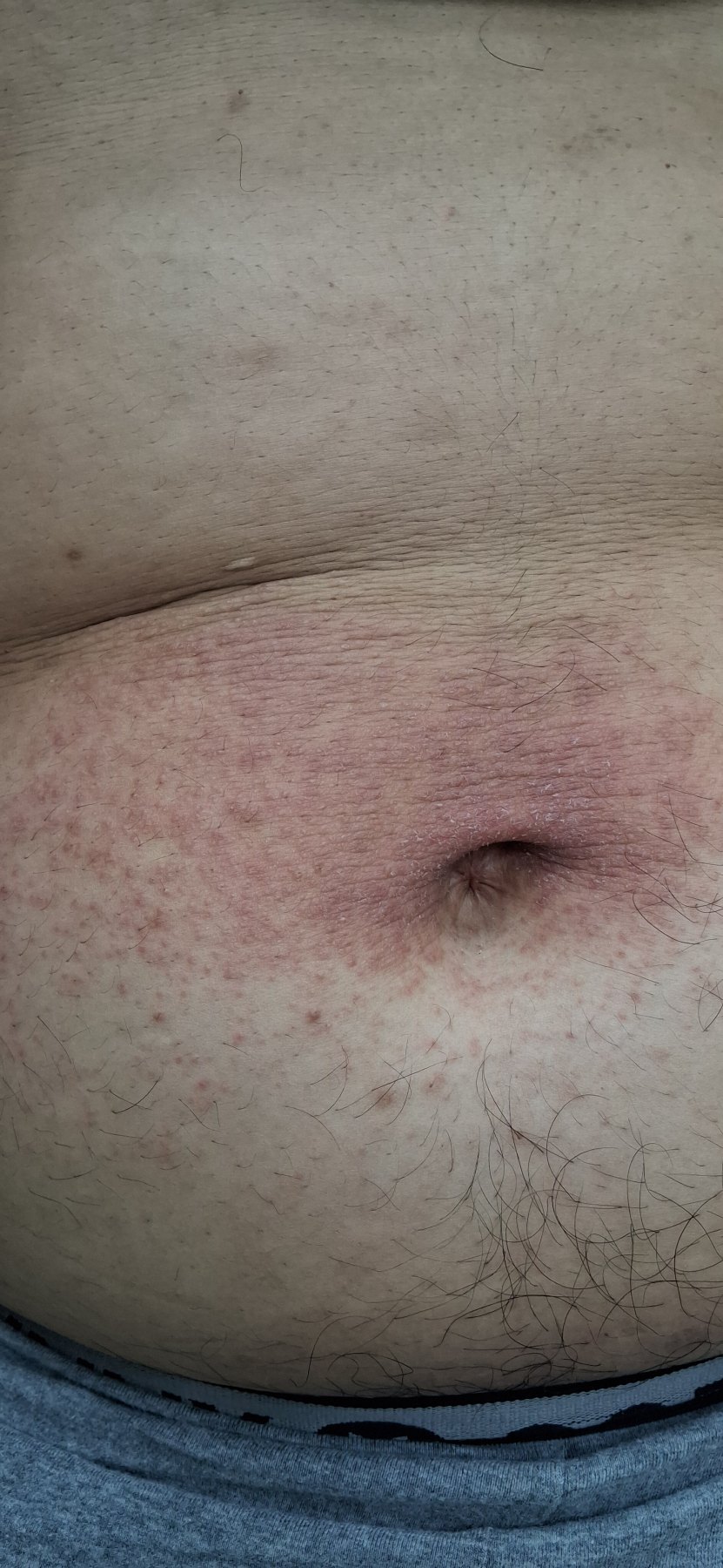 Intertrigo: before image