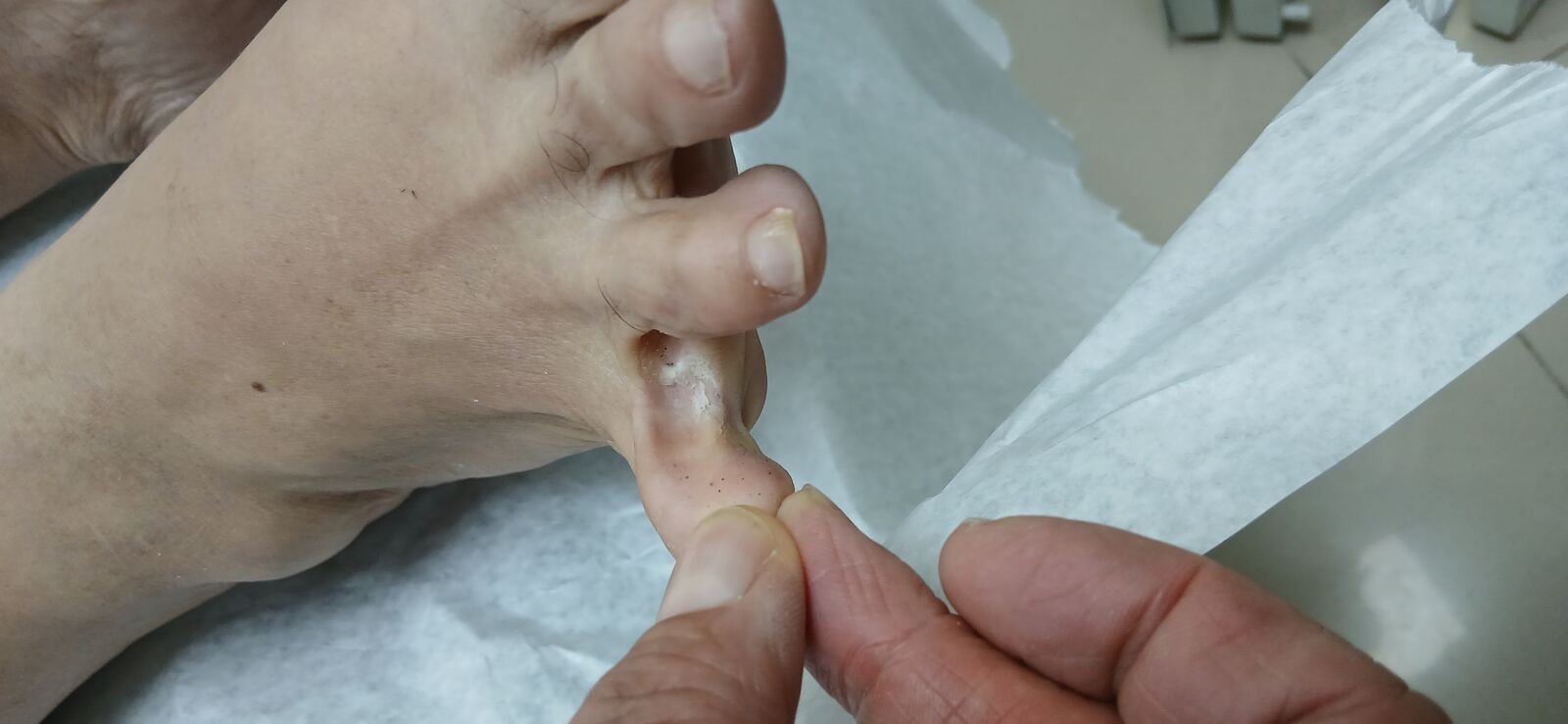 Clinical case: Intertrigo