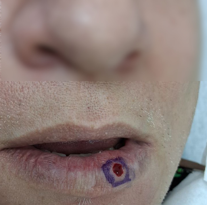 Venous lake vs nevus: before image