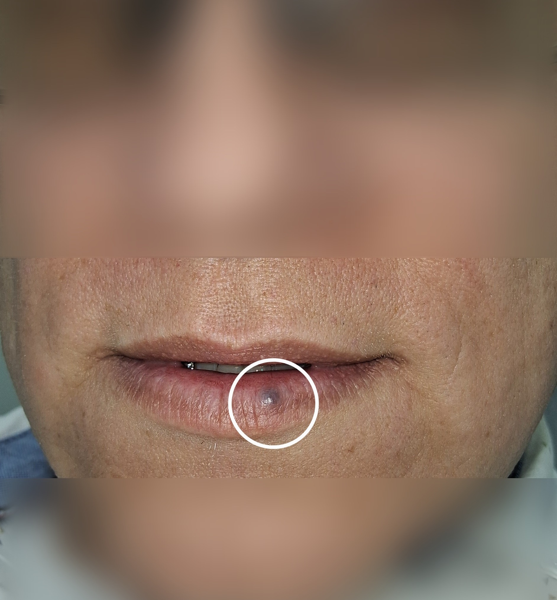 Venous lake vs nevus: after image