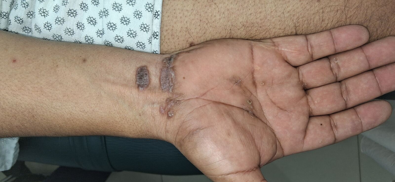 Lichen planus: before image