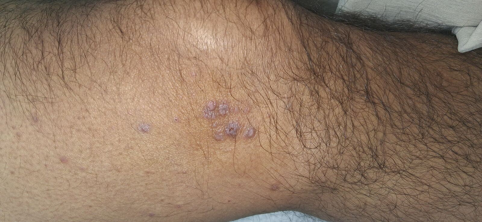 Lichen planus: after image