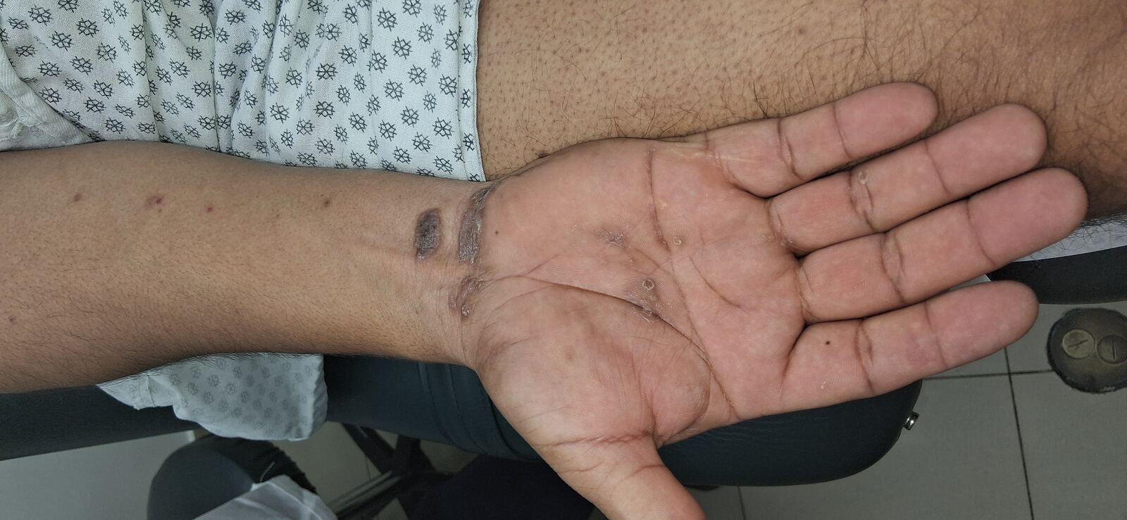 Clinical case: Lichen planus