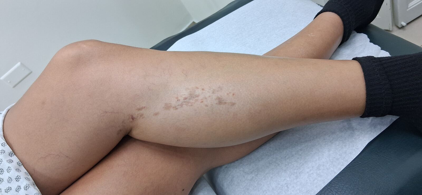 Lichen simplex chronicus: after image