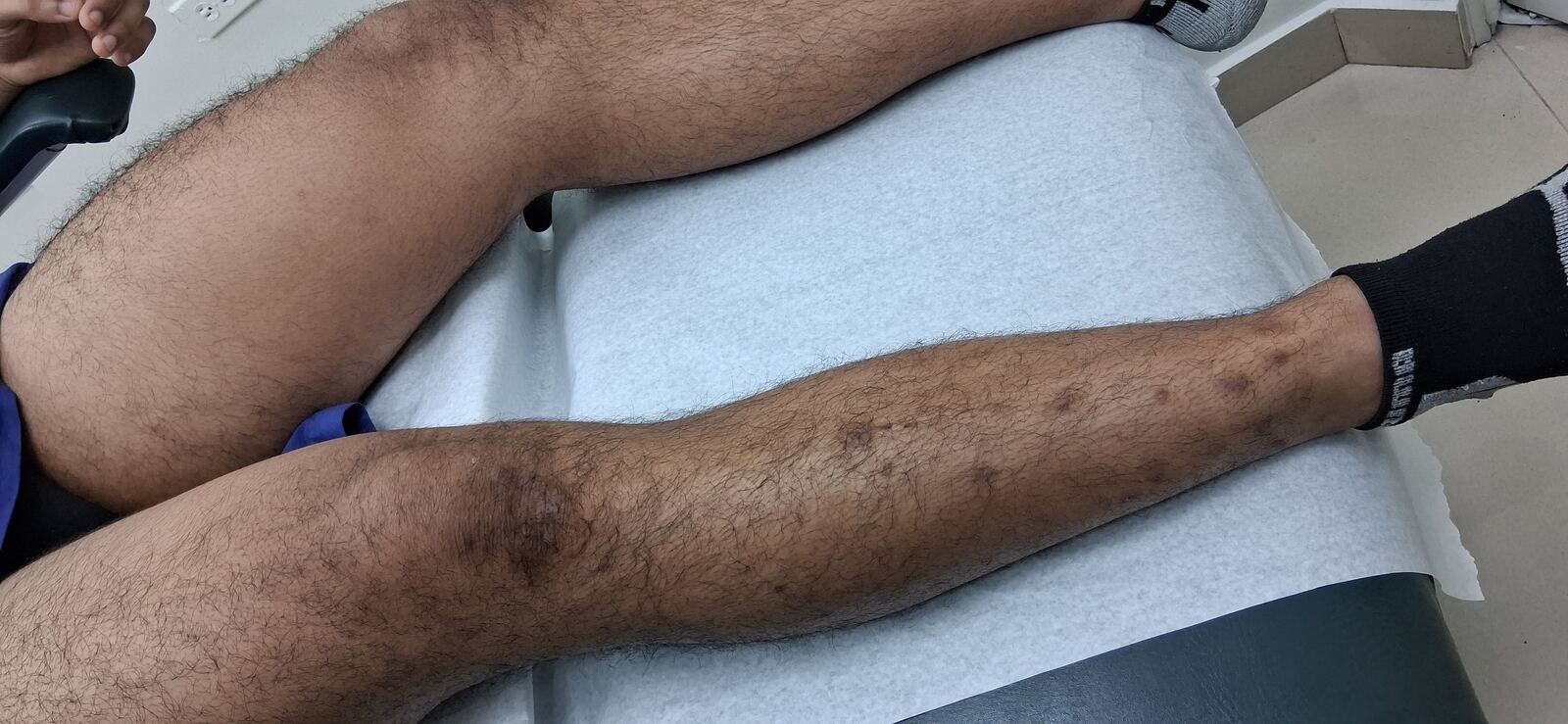 Clinical case: Lichen simplex chronicus