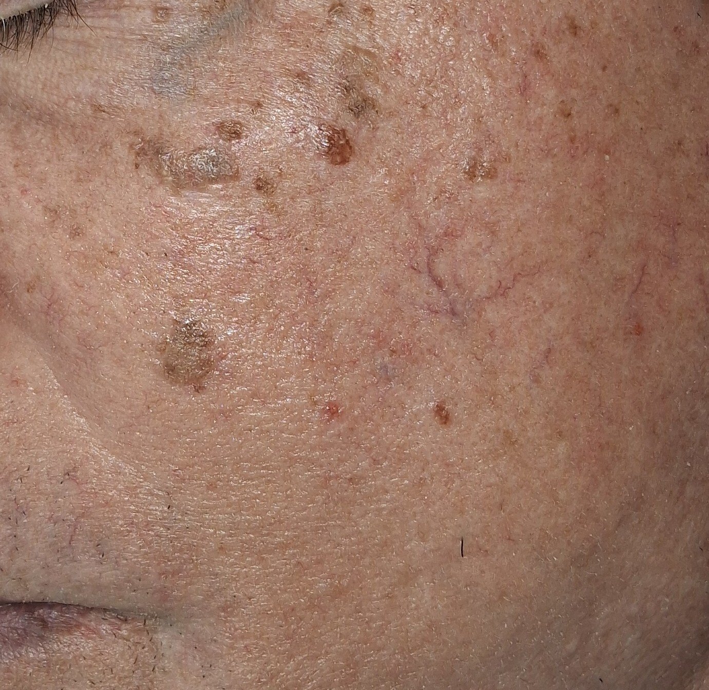 Facial spots: before image