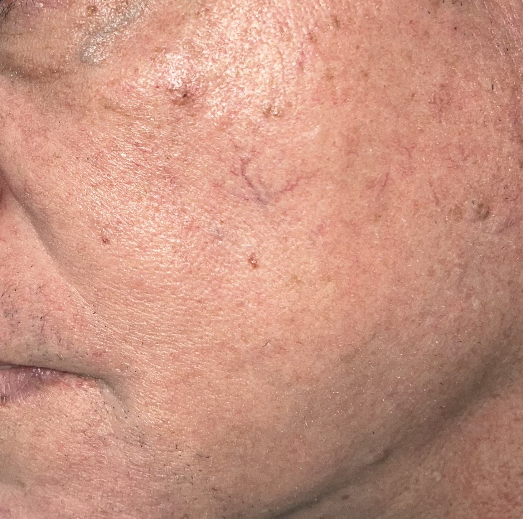 Facial spots: after image