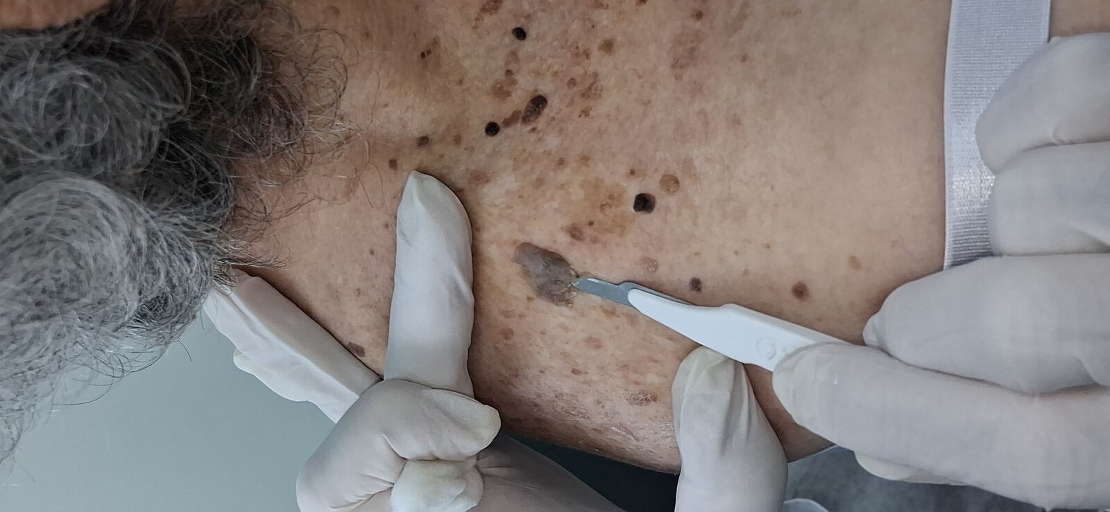 Melanoacanthoma: before image