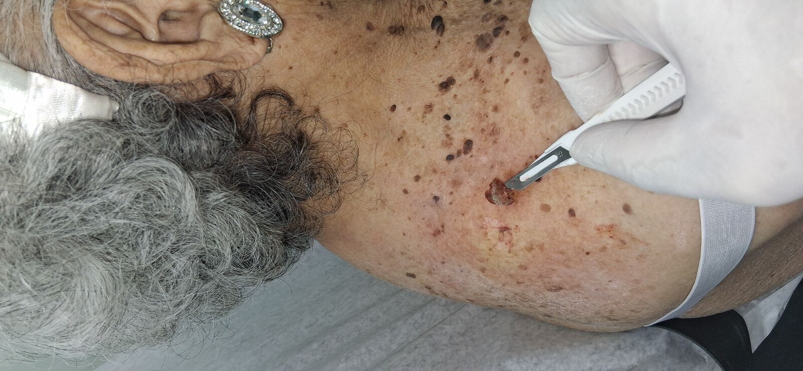 Melanoacanthoma: after image