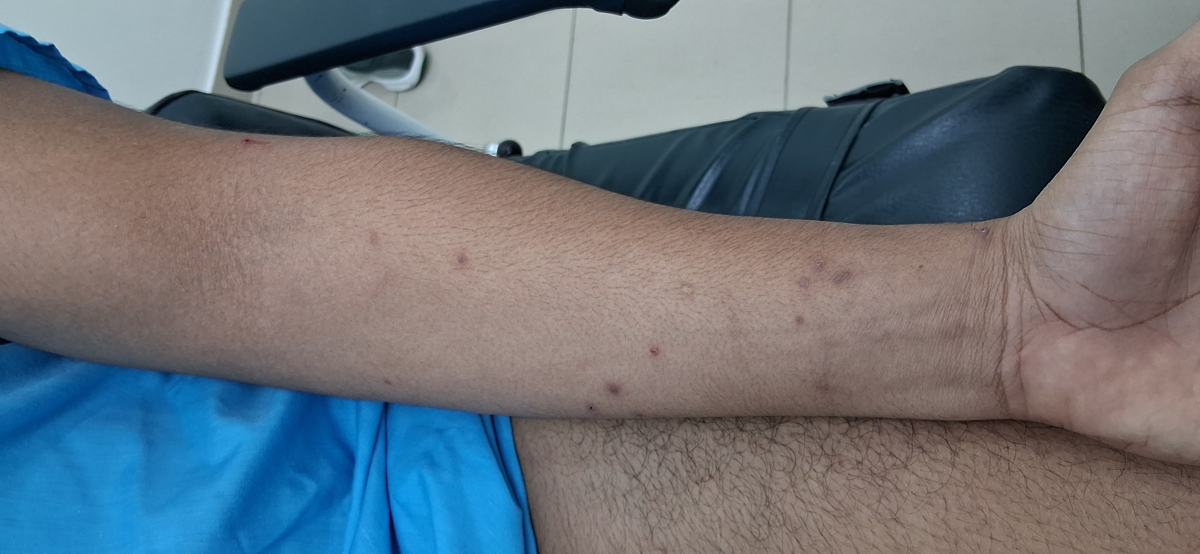 Clinical case of Molluscum contagiosum