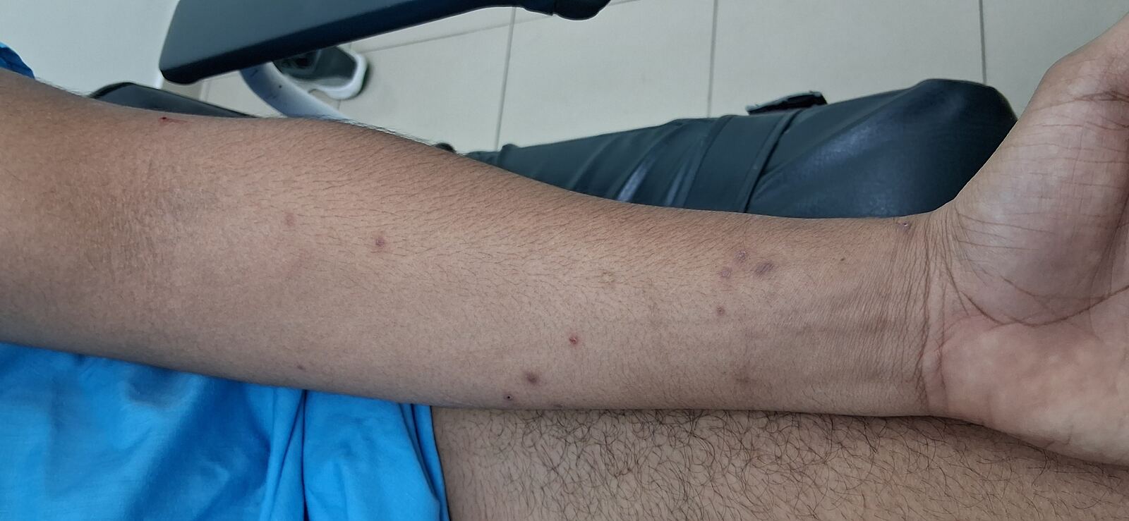Molluscum contagiosum: before image
