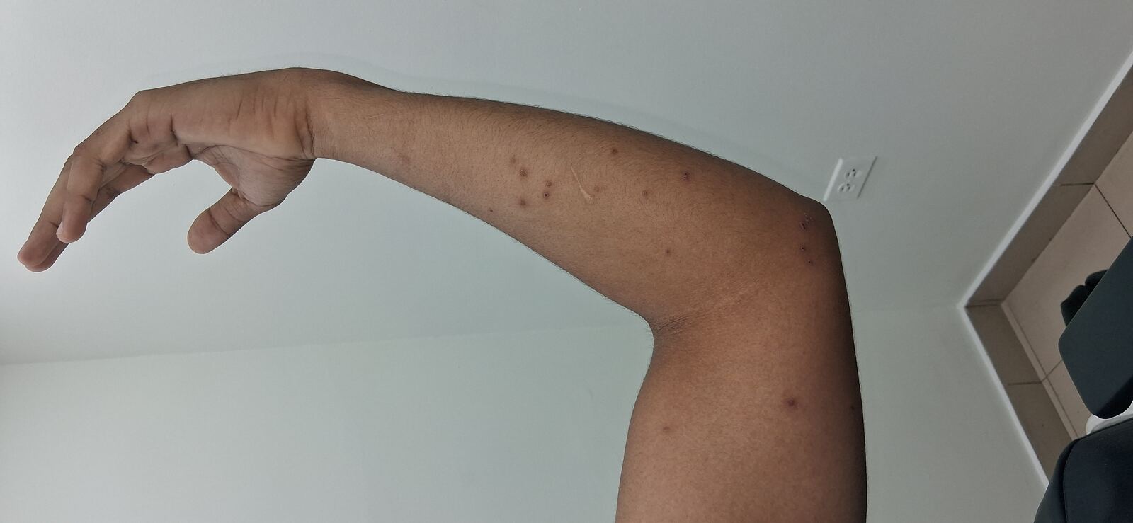 Clinical case: Molluscum contagiosum