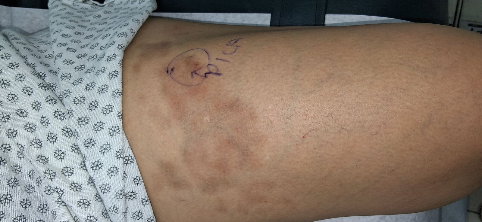 Morphea: before image