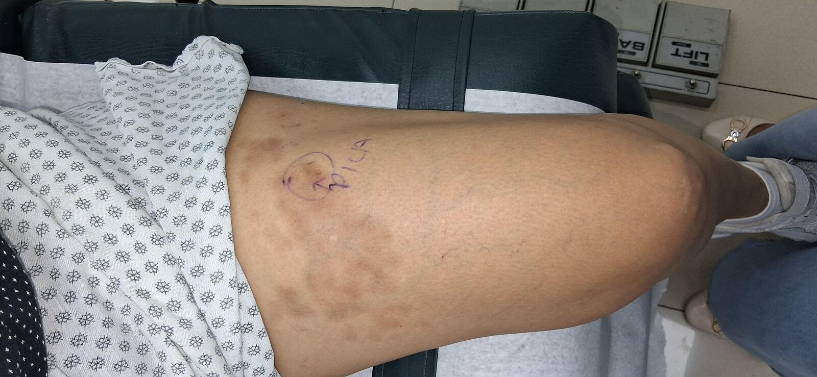Clinical case: Morphea