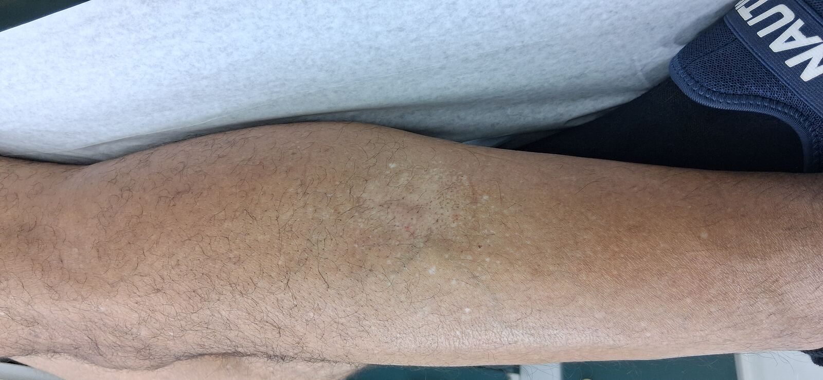 Neurodermatitis: before image