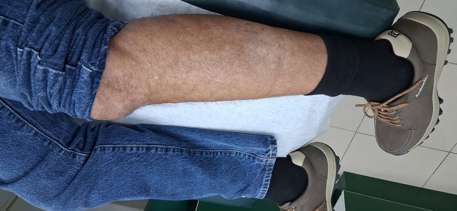 Neurodermatitis: after image