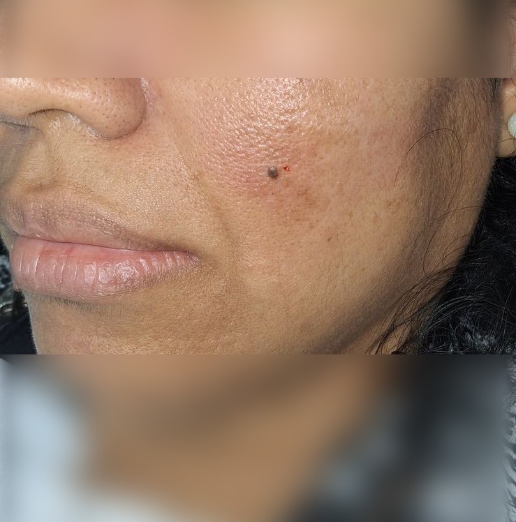 Compound nevus: before image