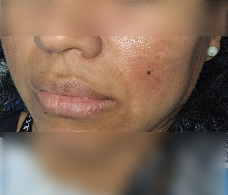 Clinical case: Compound nevus