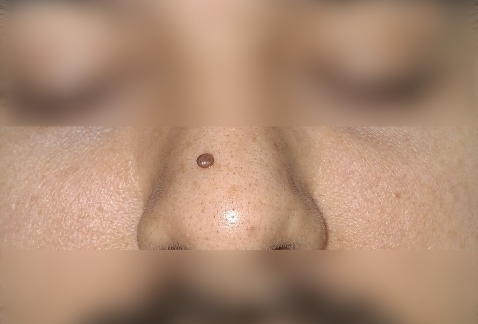 Pedunculated nevus: before image