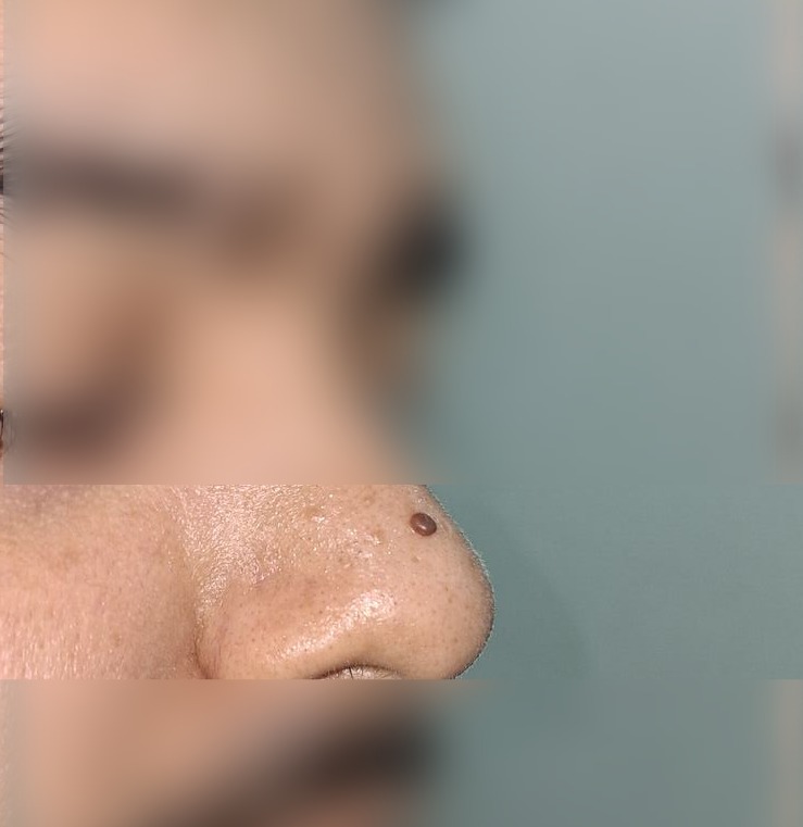 Pedunculated nevus: after image