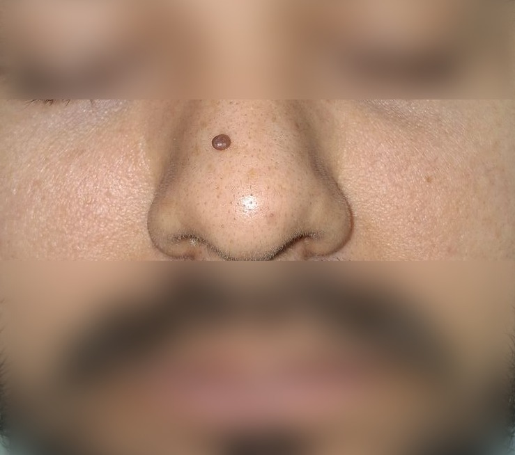 Clinical case: Pedunculated nevus