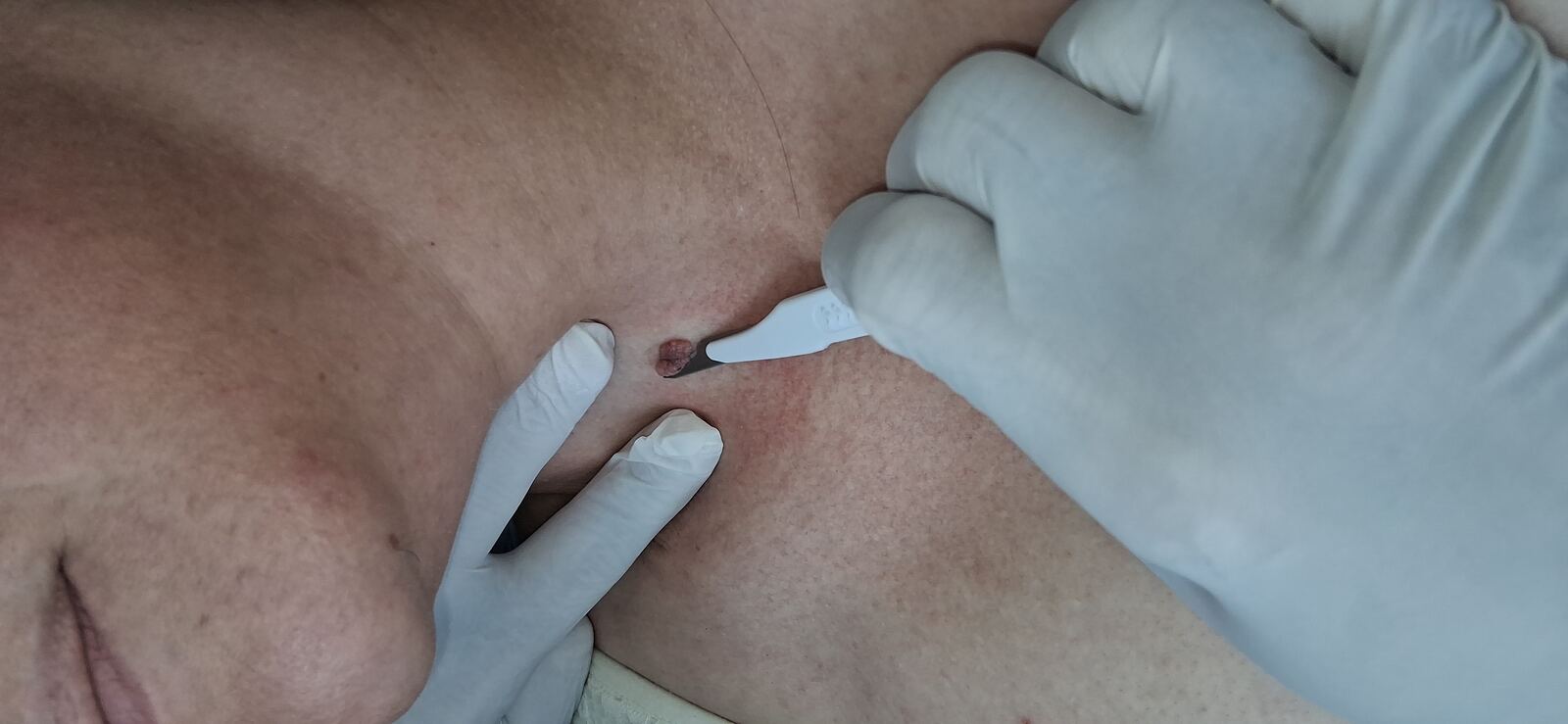 Verrucous nevus: before image