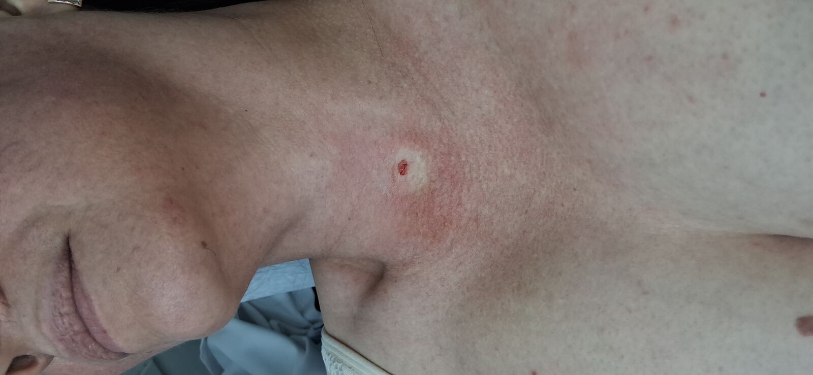 Verrucous nevus: after image