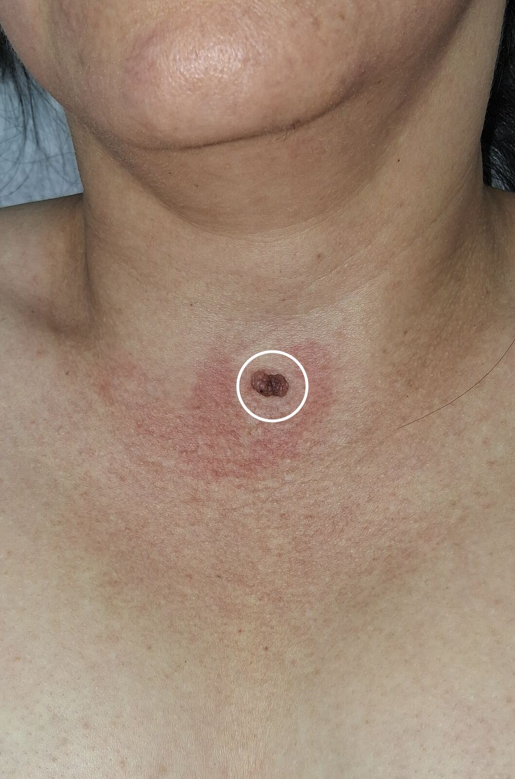 Clinical case: Verrucous nevus