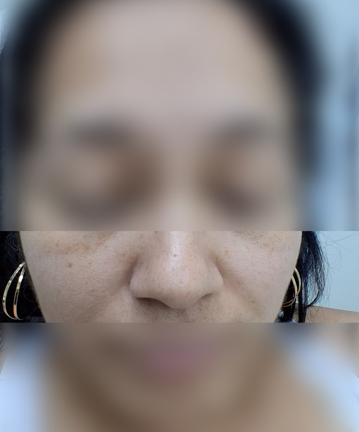 Nevus vs basal cell carcinoma: before image