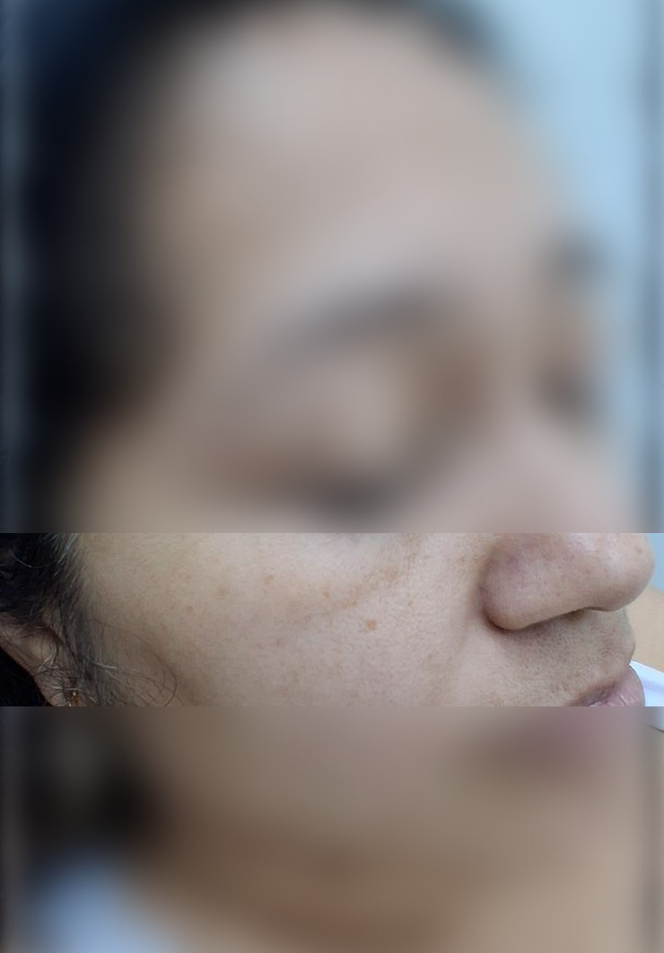 Nevus vs basal cell carcinoma: after image