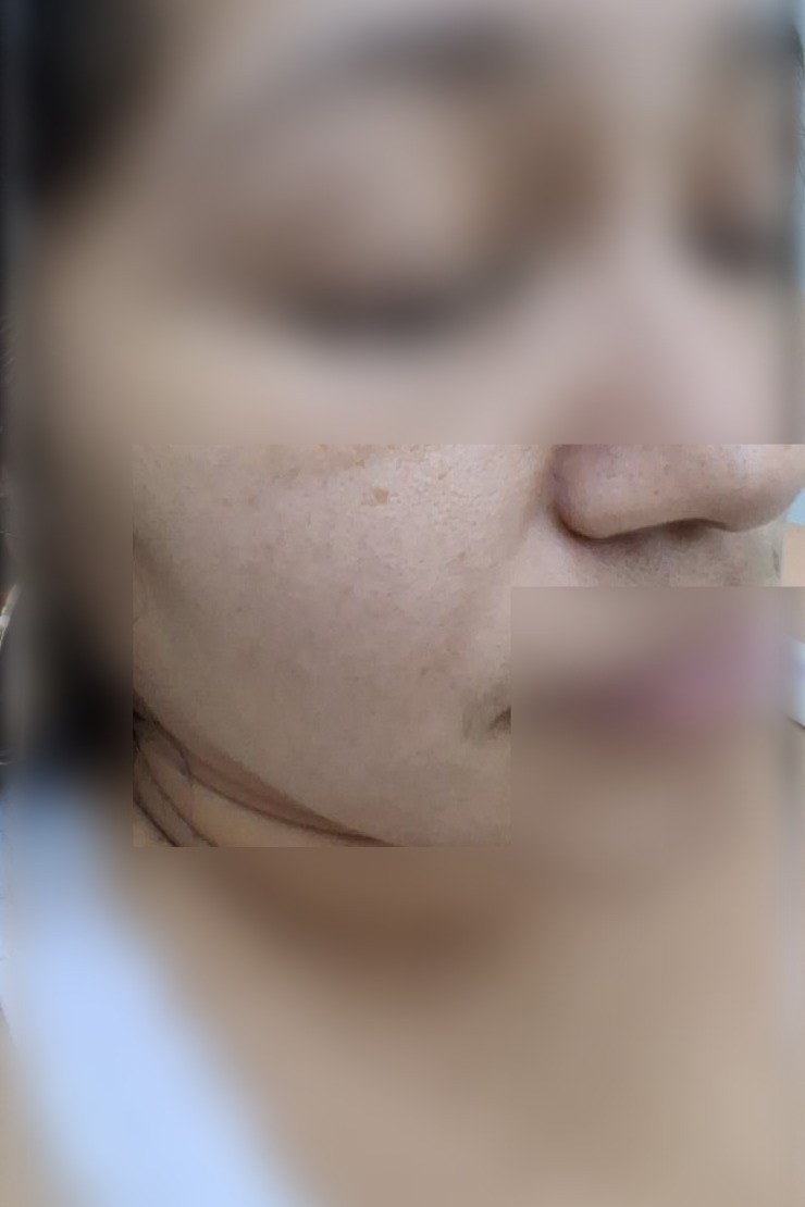 Clinical case: Nevus vs basal cell carcinoma