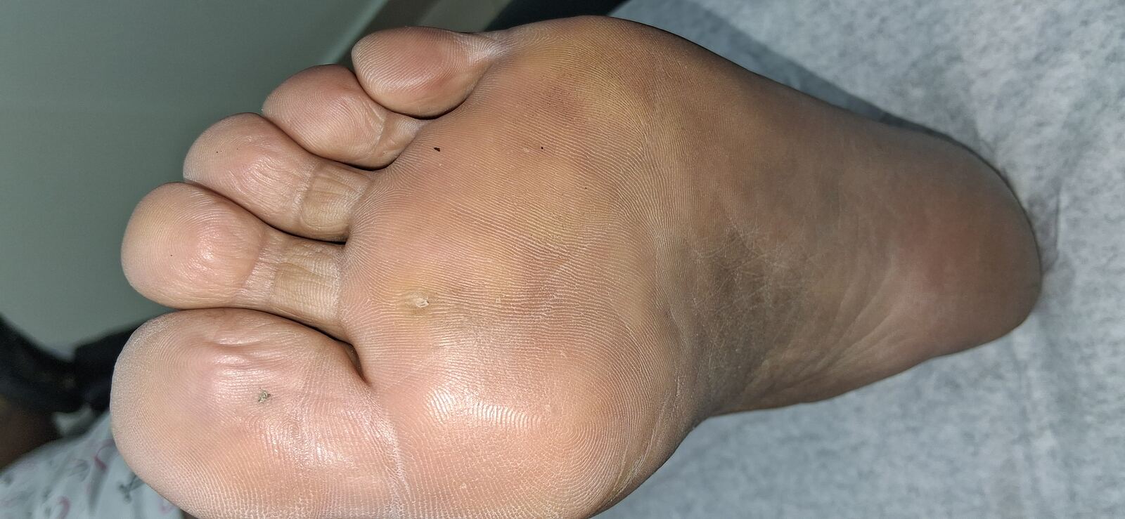 Clinical case: Plantar callus (corn)