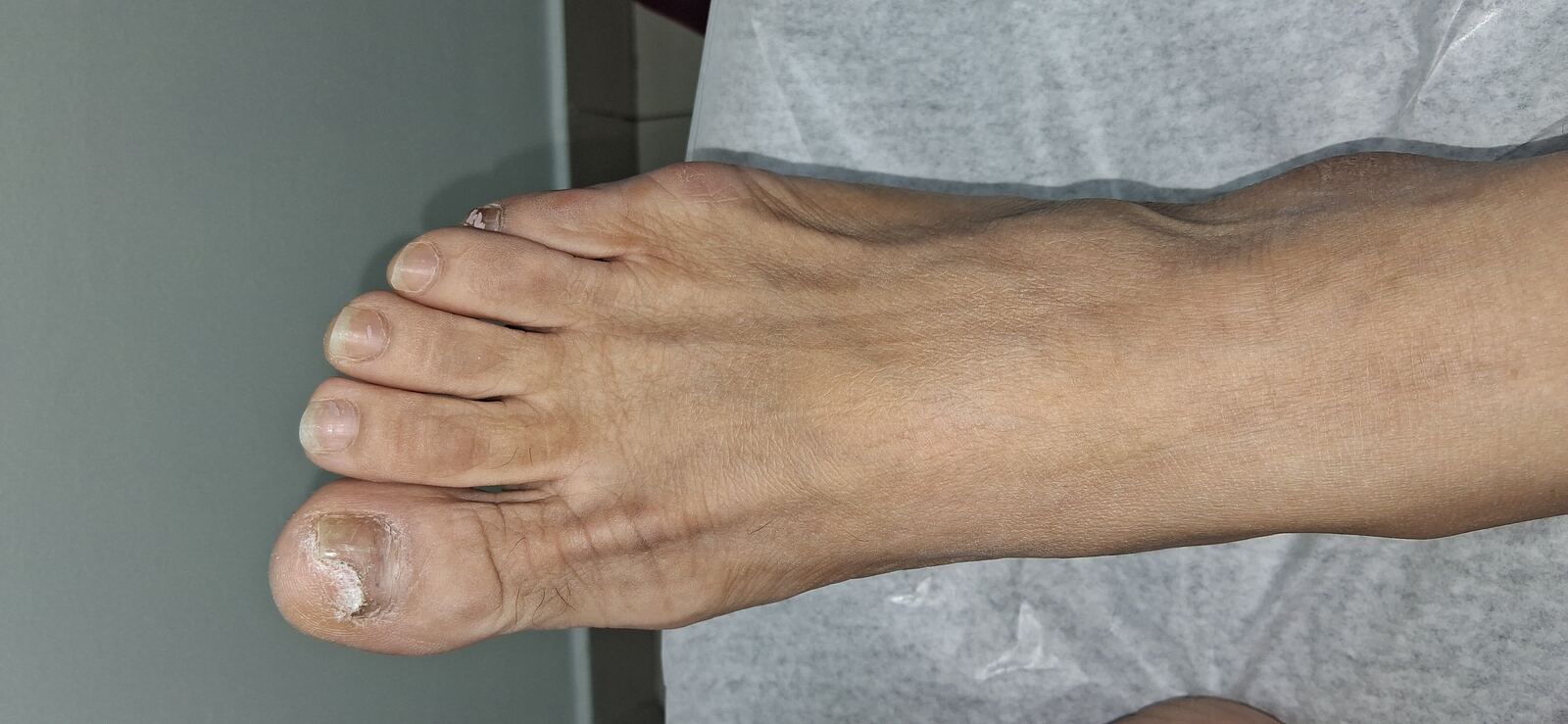 Onychomycosis of hands and feet: before image