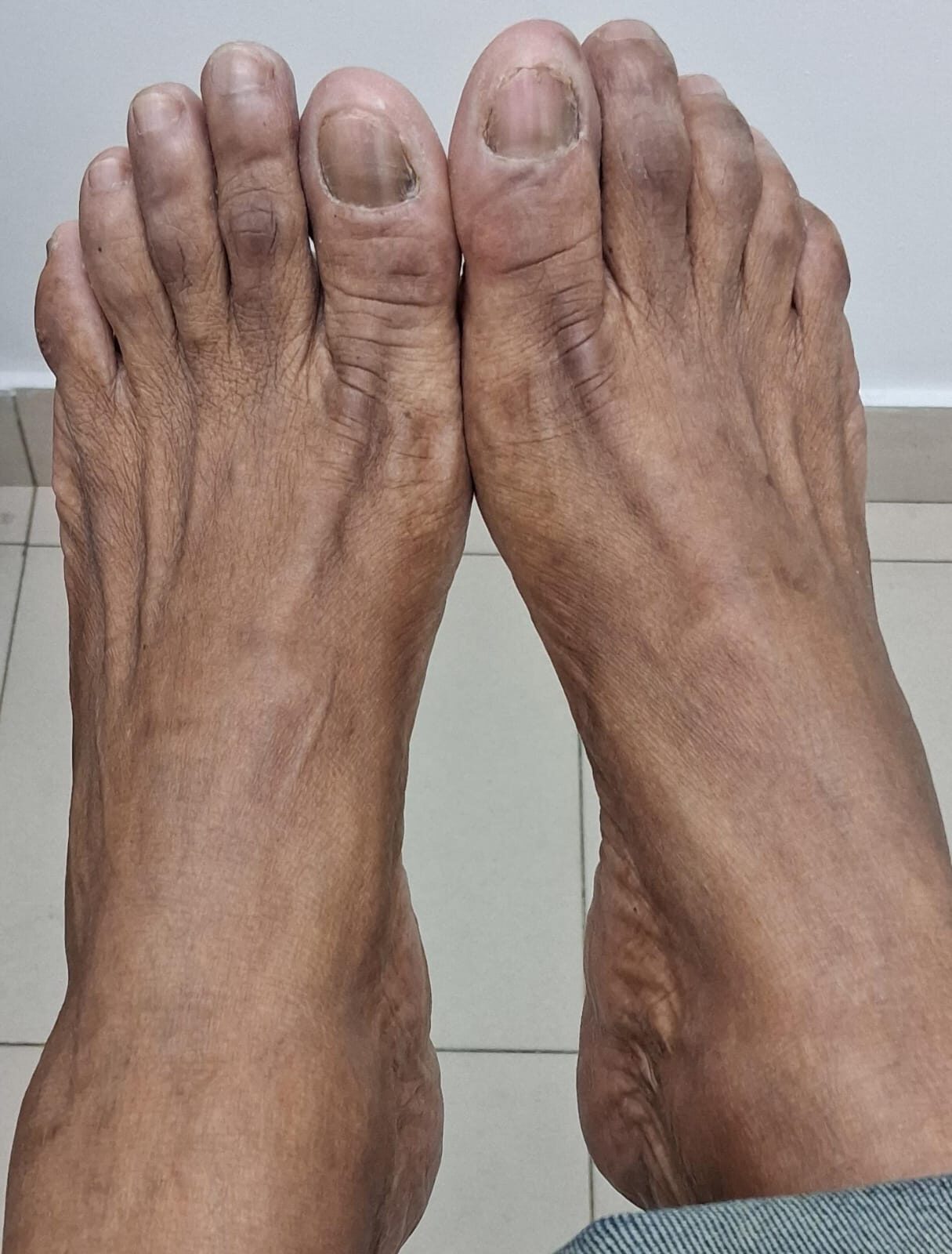 Onychomycosis of hands and feet: after image