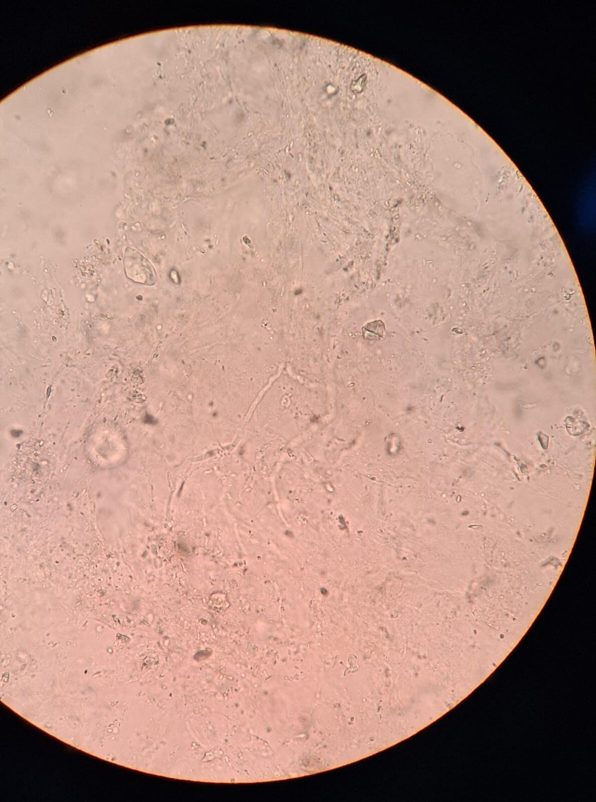 Clinical case: Onychomycosis of hands and feet