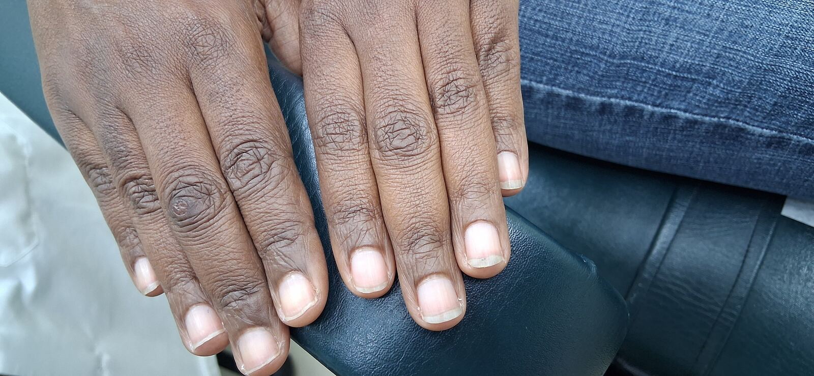 Gottron papules: before image