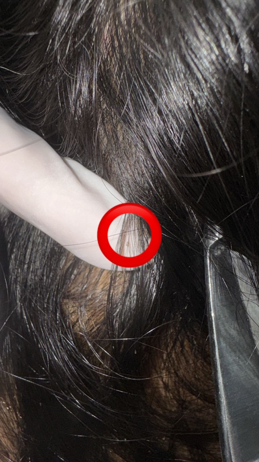 Pediculosis: before image