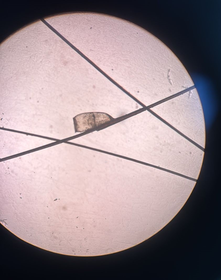 Pediculosis: after image